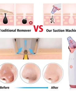 Electric Facial Vacuum Blackhead & Acne Remover with Deep Pore Cleansing